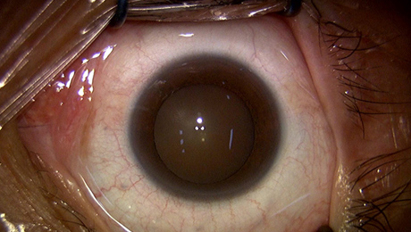 白内障手術1写真