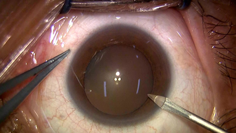 白内障手術2写真