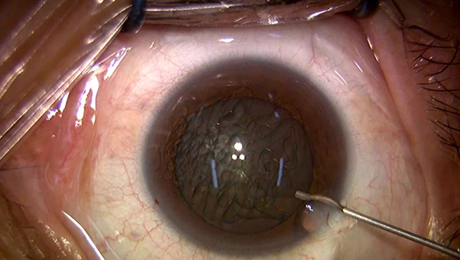 白内障手術3写真