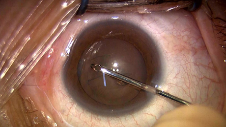 白内障手術4写真