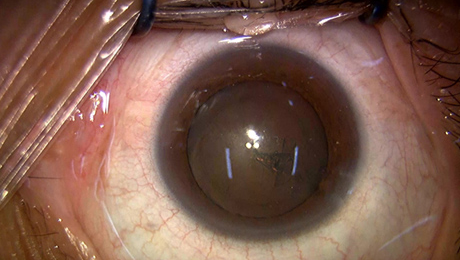 白内障手術5写真