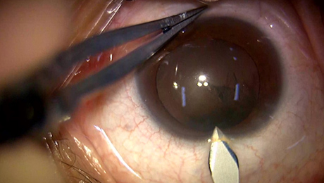 白内障手術6写真