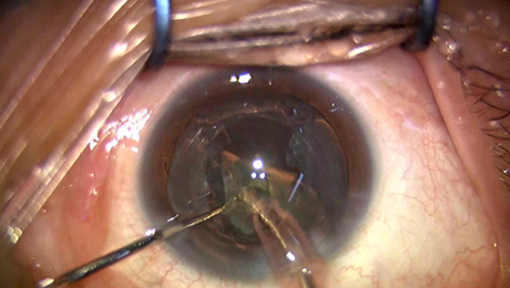 白内障手術7写真