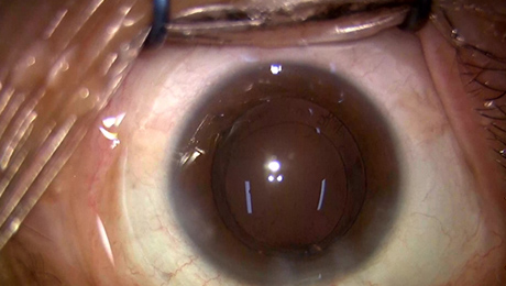 白内障手術8写真