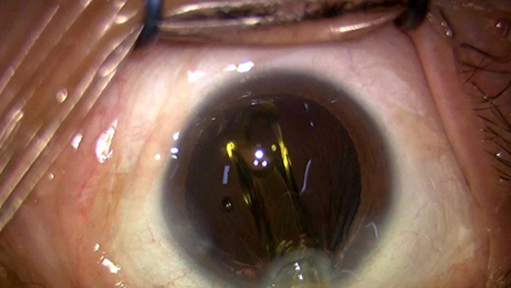 白内障手術9写真