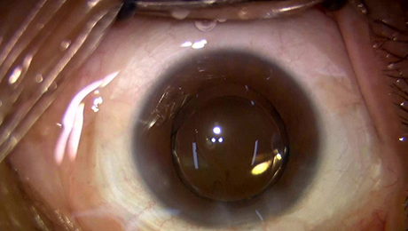 白内障手術10写真