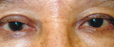 加齢性の眼瞼下垂症手術後の眼底写真