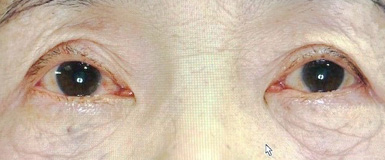 加齢性眼瞼下垂症手術後の眼底写真