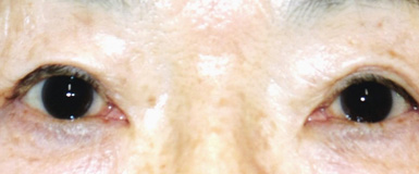 眼瞼皮膚弛緩症手術後の眼底写真