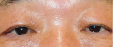 眼瞼皮膚弛緩症手術後の眼底写真