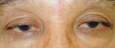 加齢性の眼瞼下垂症手術前の眼底写真
