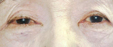 加齢性眼瞼下垂症手術前の眼底写真