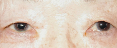 眼瞼皮膚弛緩症手術前の眼底写真
