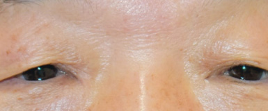 眼瞼皮膚弛緩症手術前の眼底写真