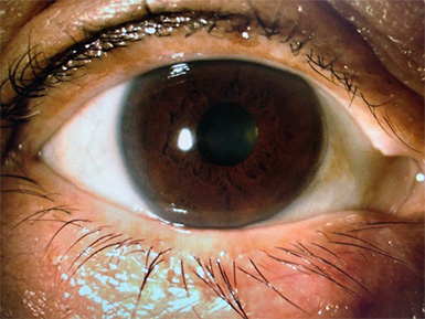 眼瞼内反症手術後の眼底写真