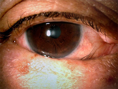 眼瞼内反症手術前の眼底写真