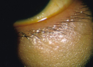 眼瞼腫瘍手術後の眼底写真