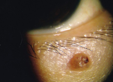 眼瞼腫瘍手術前の眼底写真