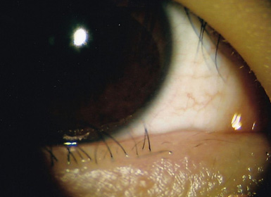 眼瞼腫瘍手術後の眼底写真