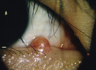 眼瞼腫瘍手術前の眼底写真