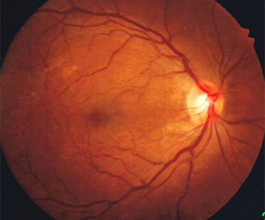 黄斑前膜手術後の眼底写真