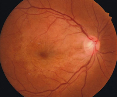 黄斑前膜手術前の眼底写真