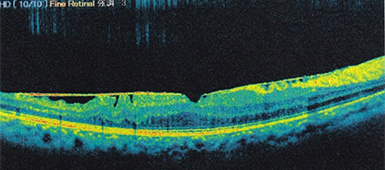 黄手術前の網膜断層写真