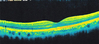 網膜剥離手術前の網膜断層写真