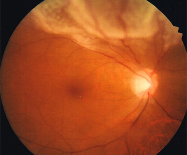 網膜剥離手術前の眼底写真