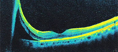 網膜剥離手術前の網膜断層写真