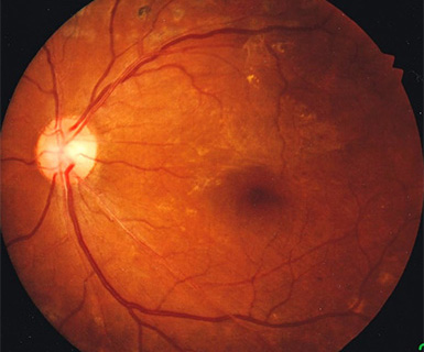 糖尿病網膜症手術後の写真