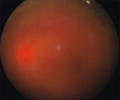 糖尿病網膜症手術前の写真