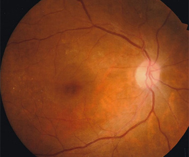 黄斑円孔手術後の眼底写真