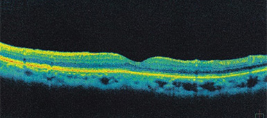 手術後の網膜断層写真