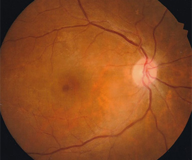 黄斑円孔手術前の眼底写真