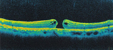 手術前の網膜断層写真