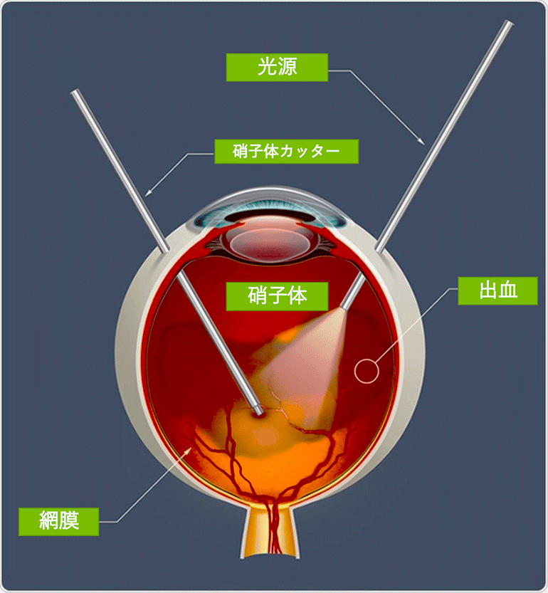 網膜硝子体手術